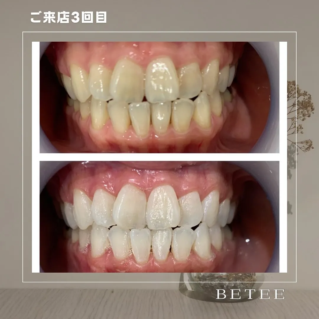 @whitening_betee 