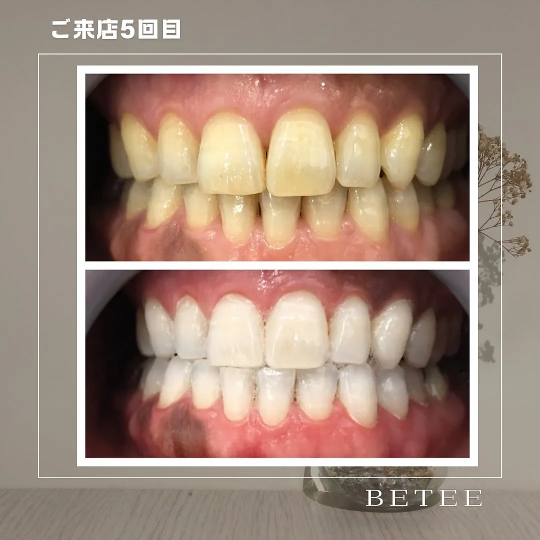 @whitening_betee 