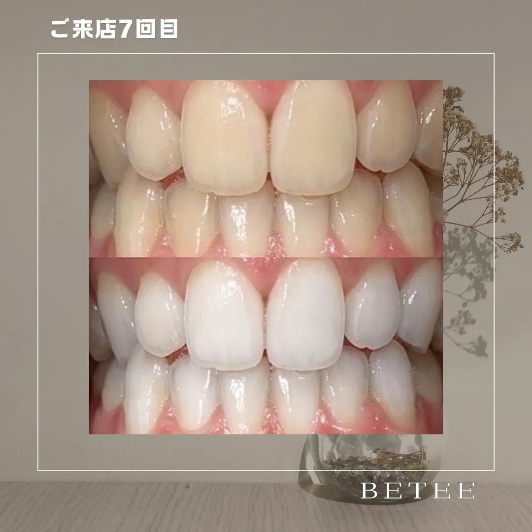 @whitening_betee