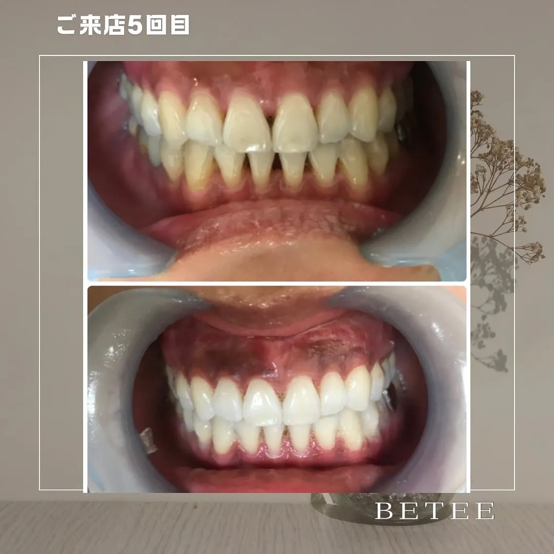 @whitening_betee