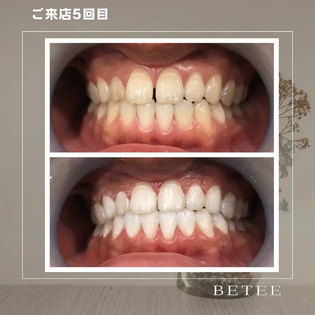 @whitening_betee