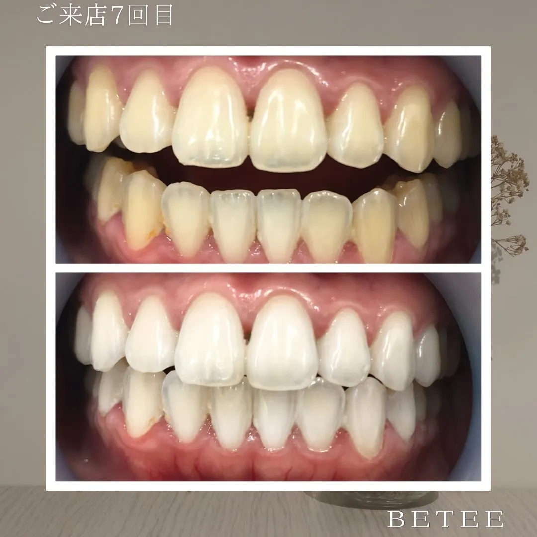 @whitening_betee