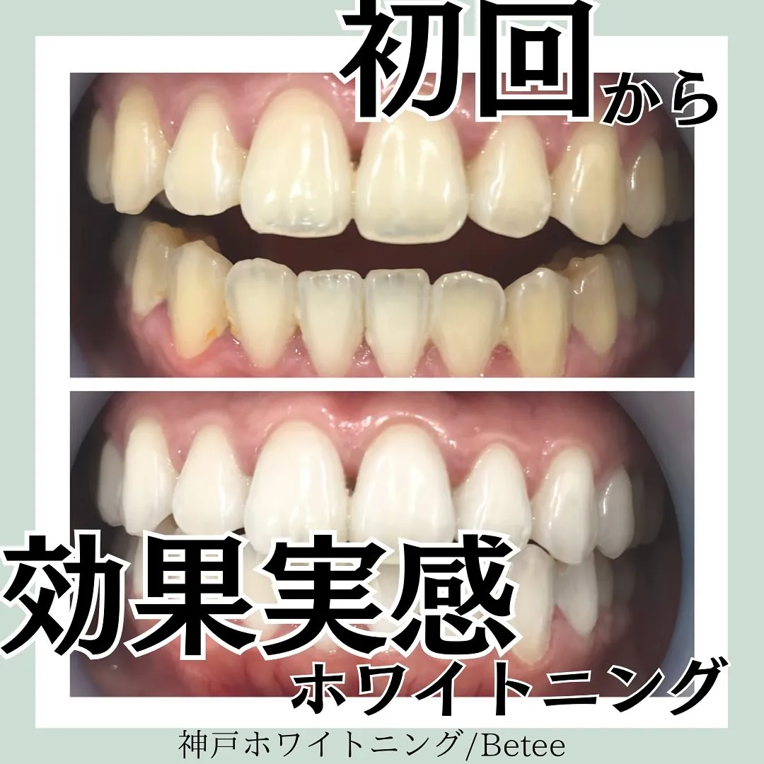 @whitening_betee ホワイトニング