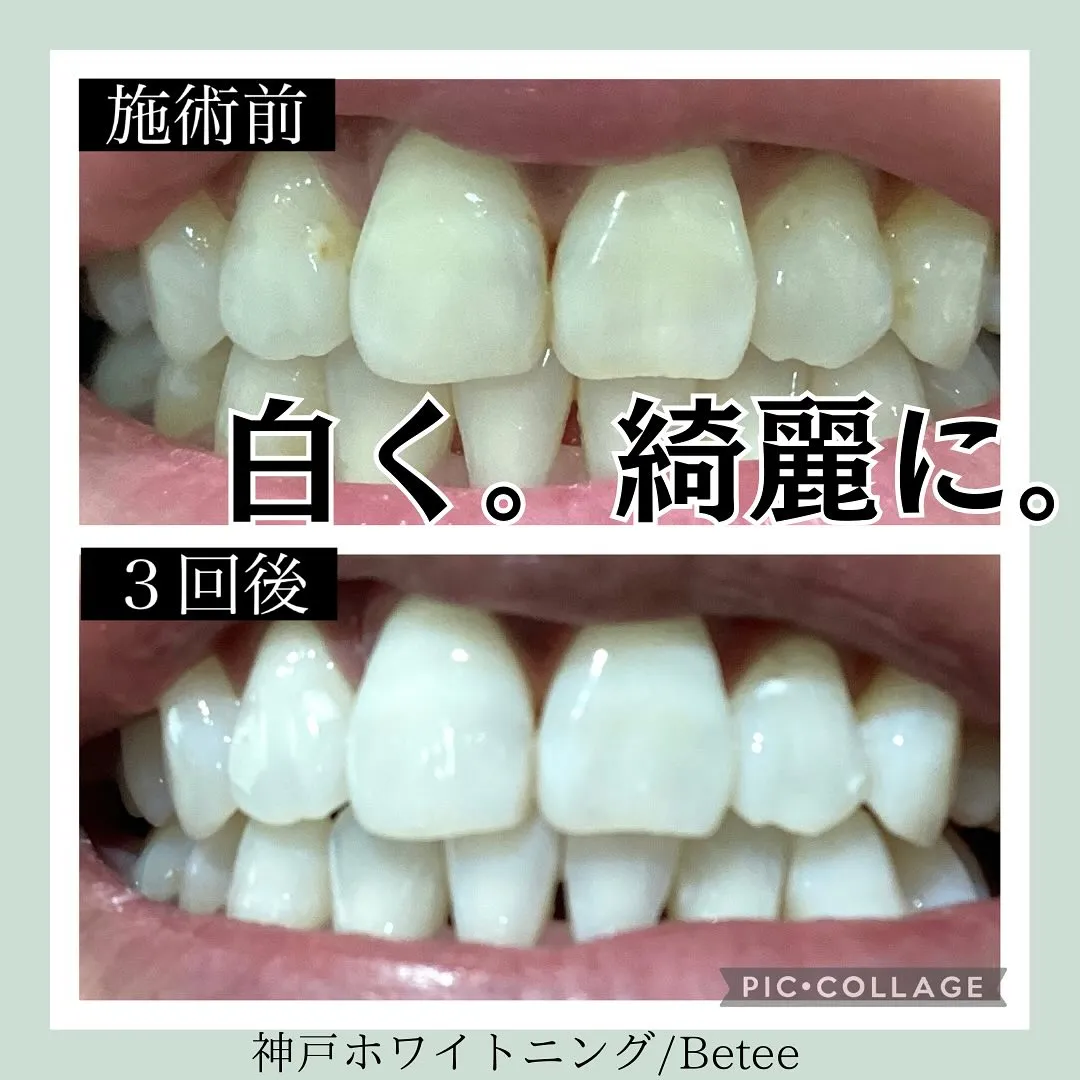 @whitening_betee ホワイトニング