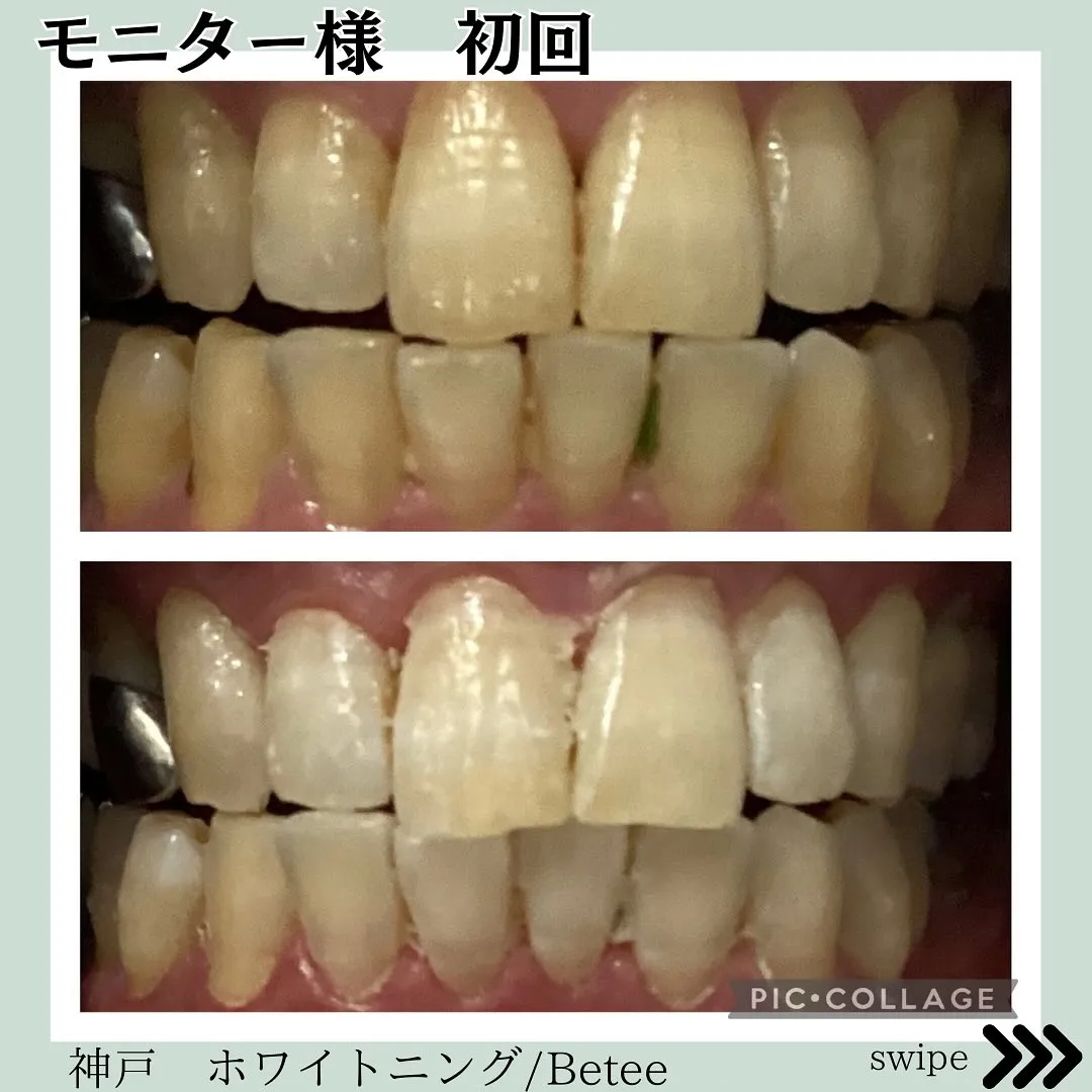 @whitening_betee ホワイトニング