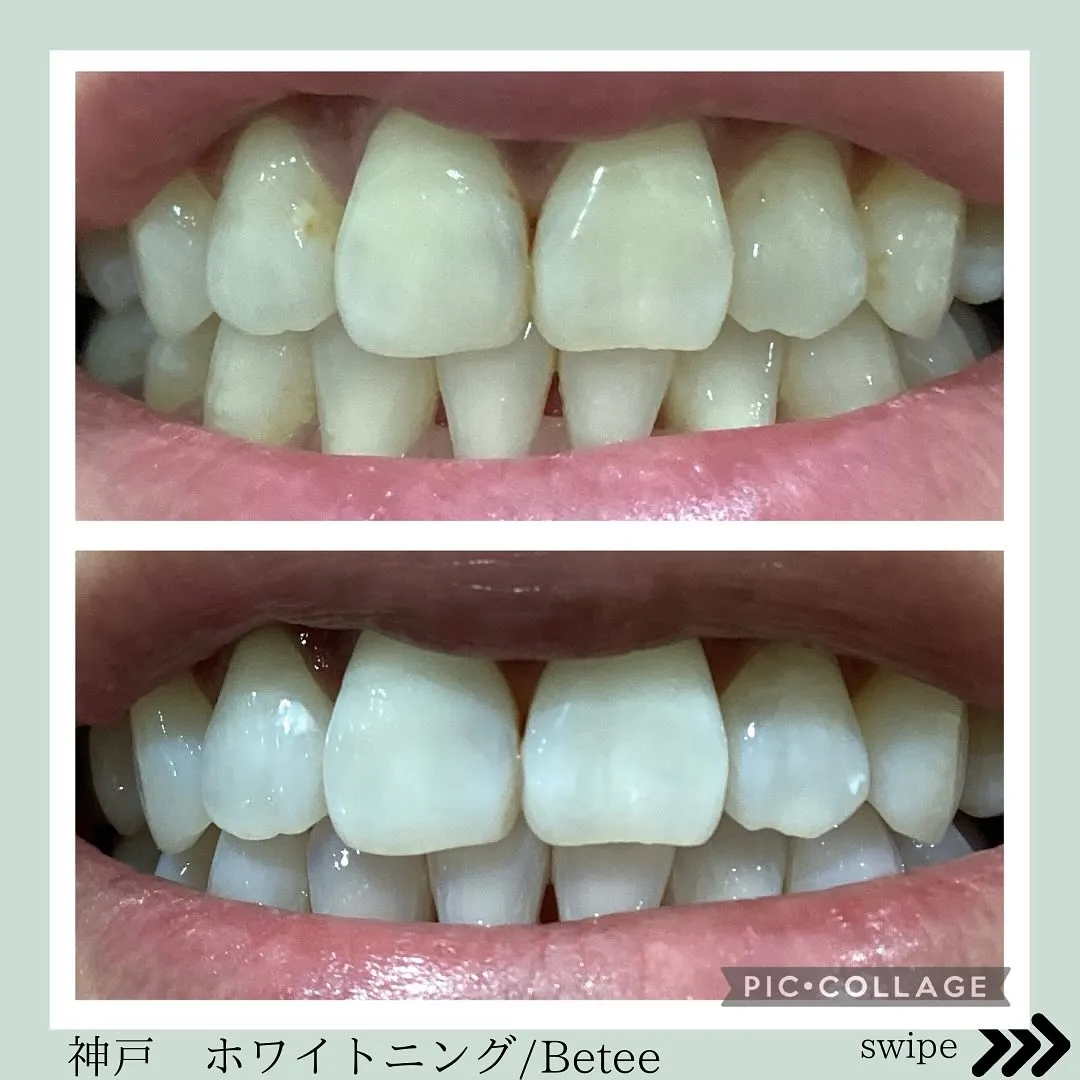 @whitening_betee ホワイトニング