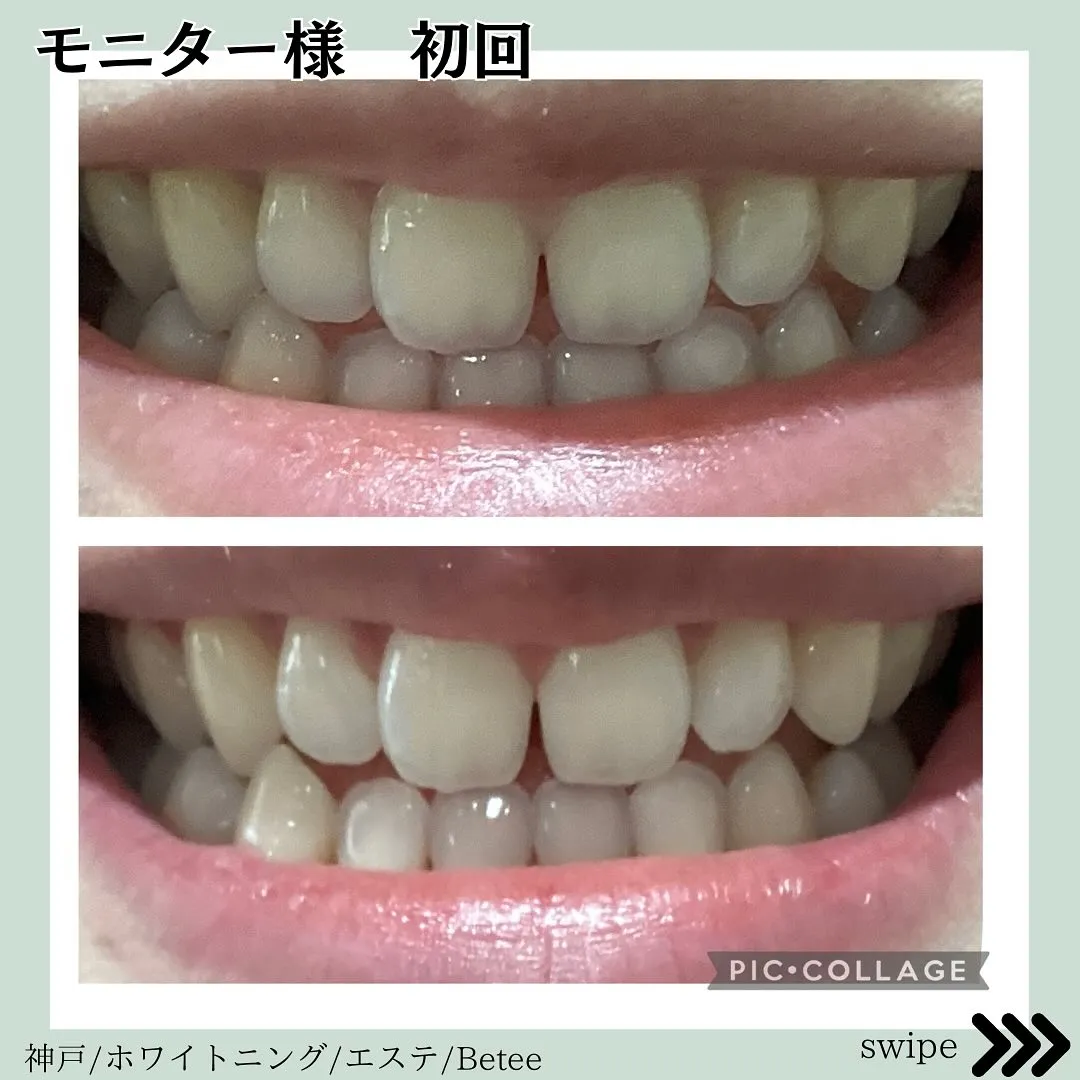 @whitening_betee ホワイトニング