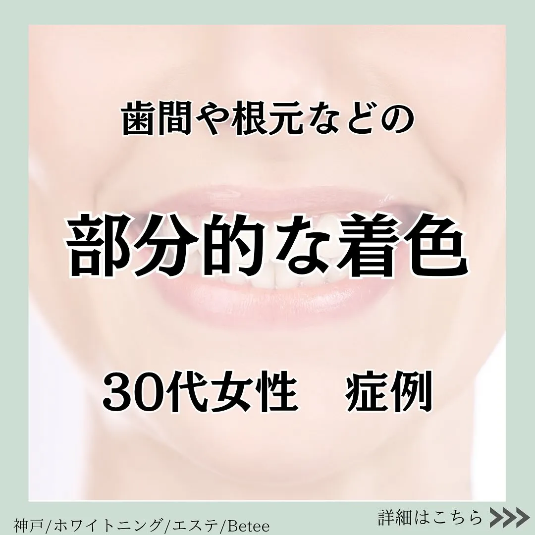 @whitening_betee ホワイトニング