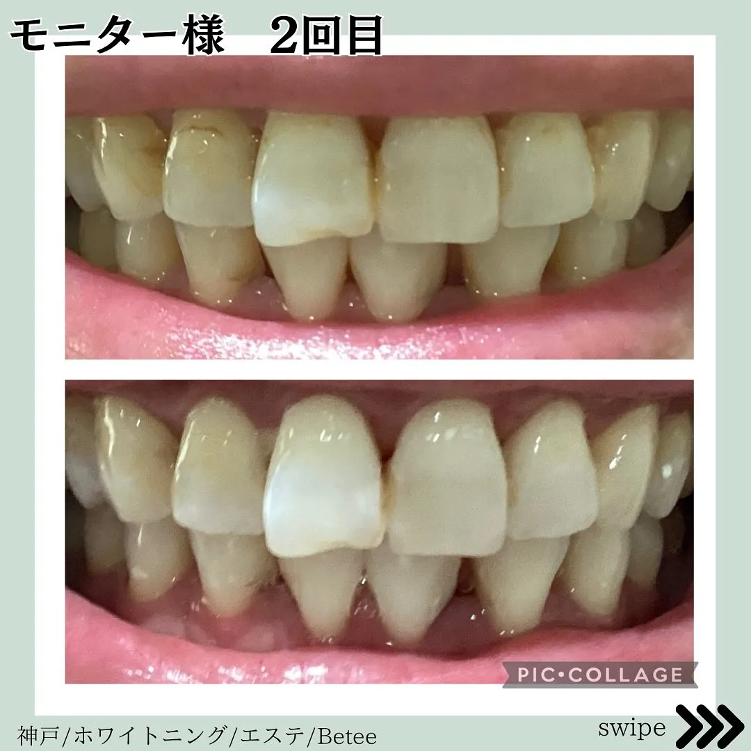 @whitening_betee ホワイトニング