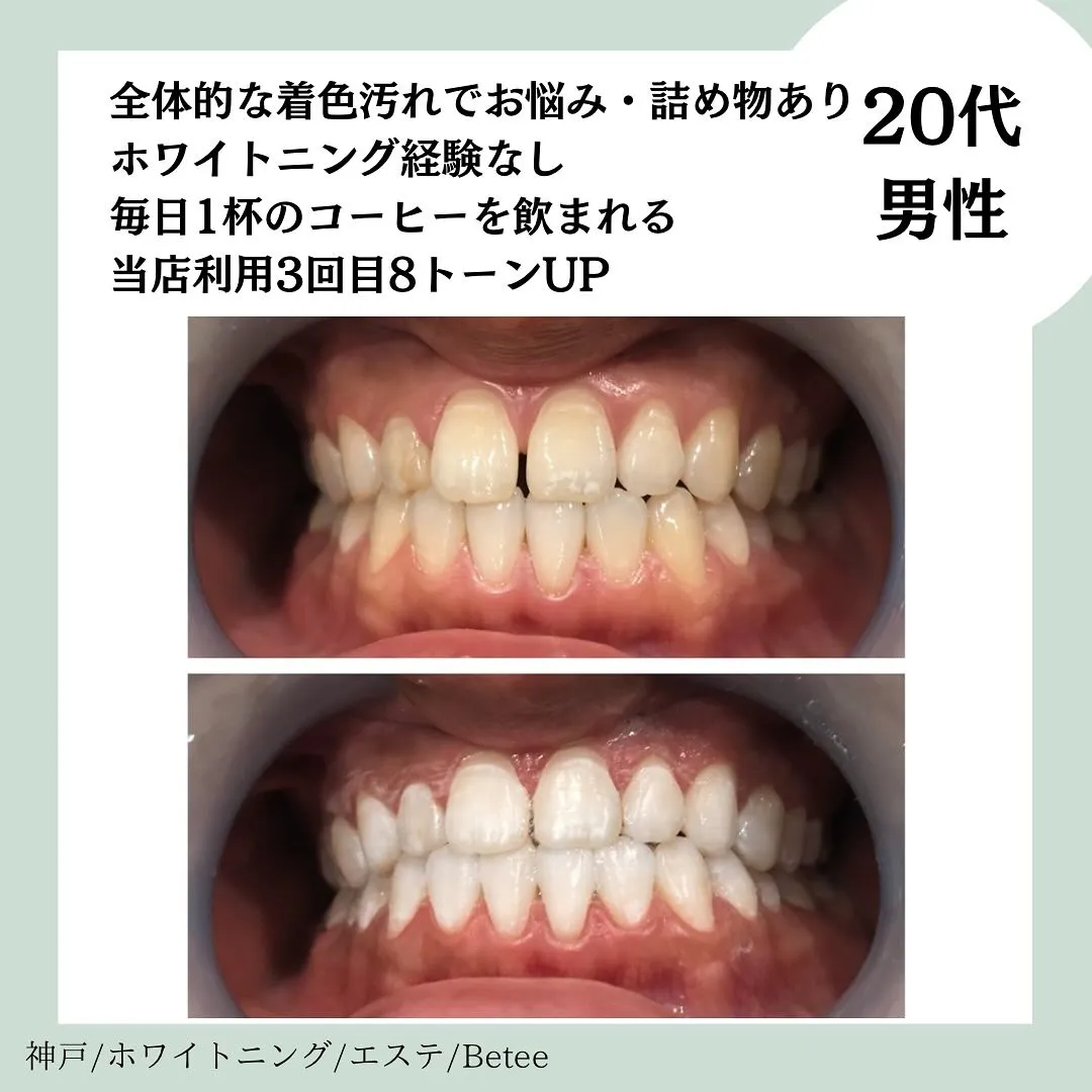 @whitening_betee ホワイトニング