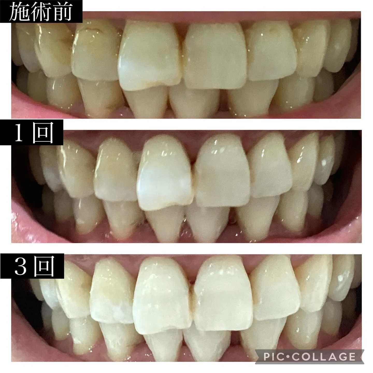 @whitening_betee ホワイトニング