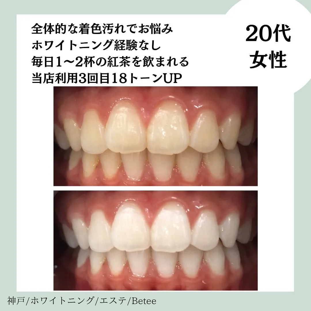 @whitening_betee ホワイトニング