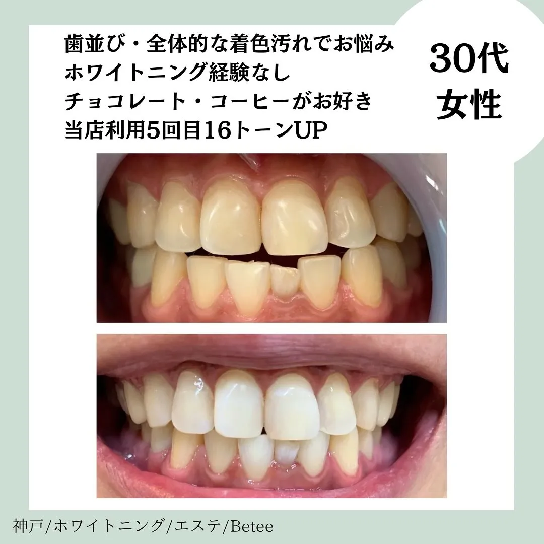 @whitening_betee ホワイトニング