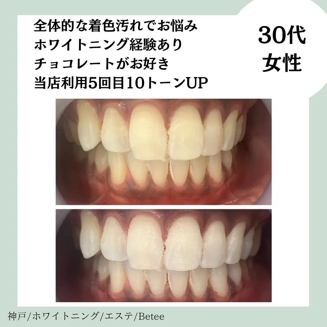 @whitening_betee ホワイトニング