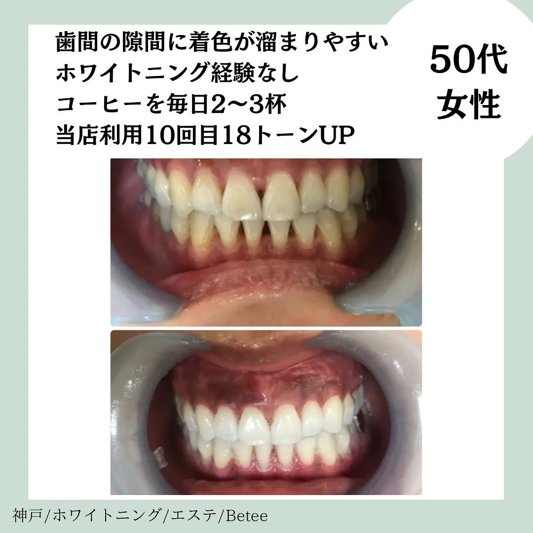 @whitening_betee ホワイトニング