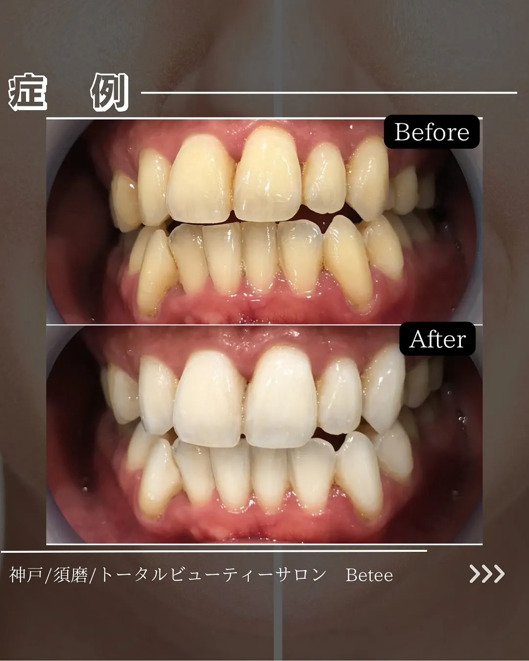 @whitening_betee ホワイトニング