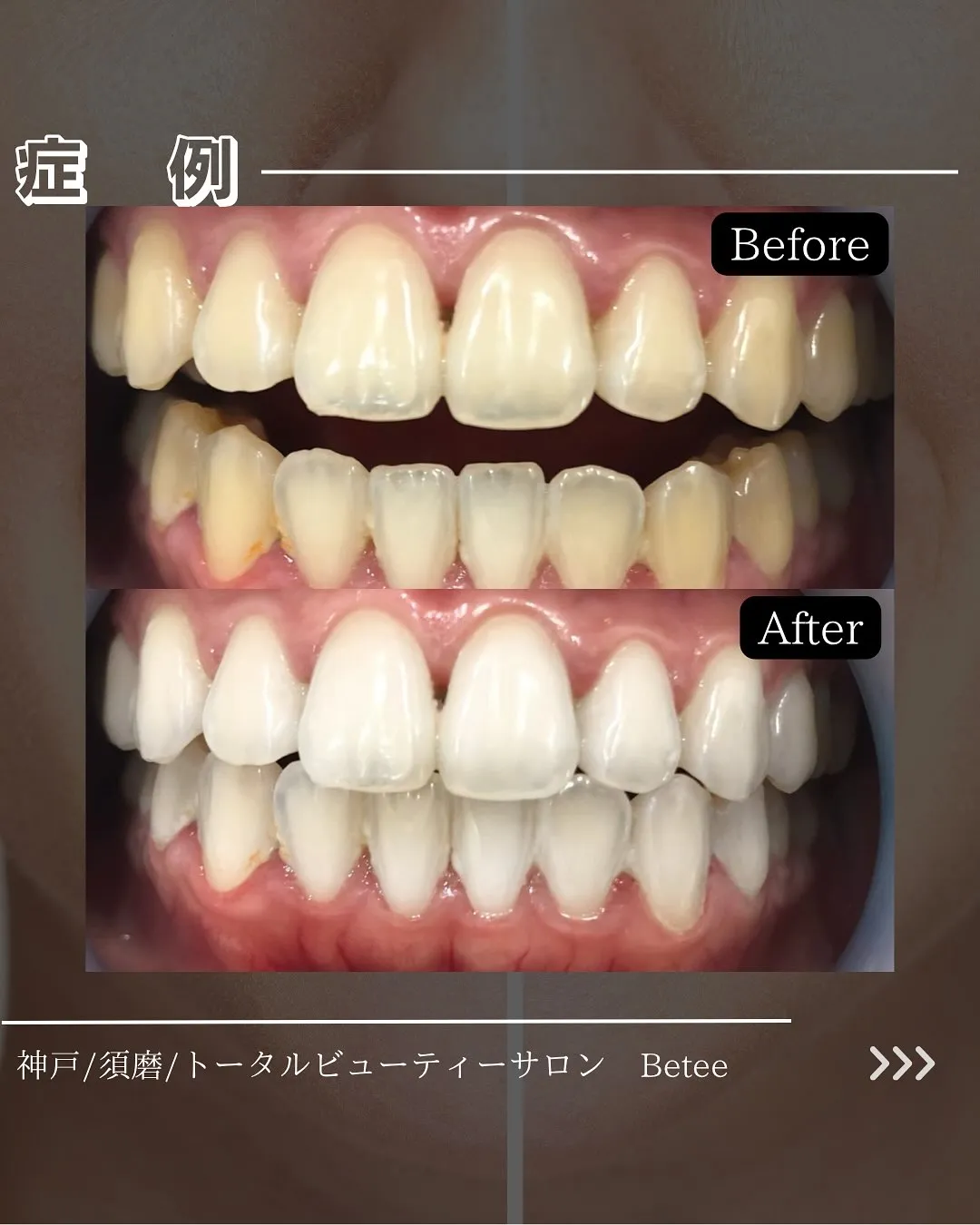 @whitening_betee ホワイトニング