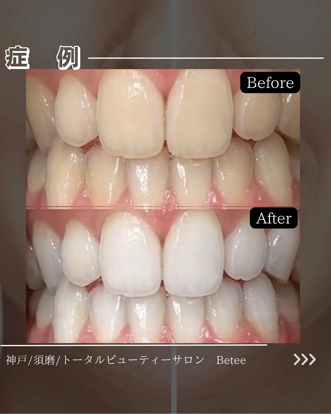 @whitening_betee ホワイトニング