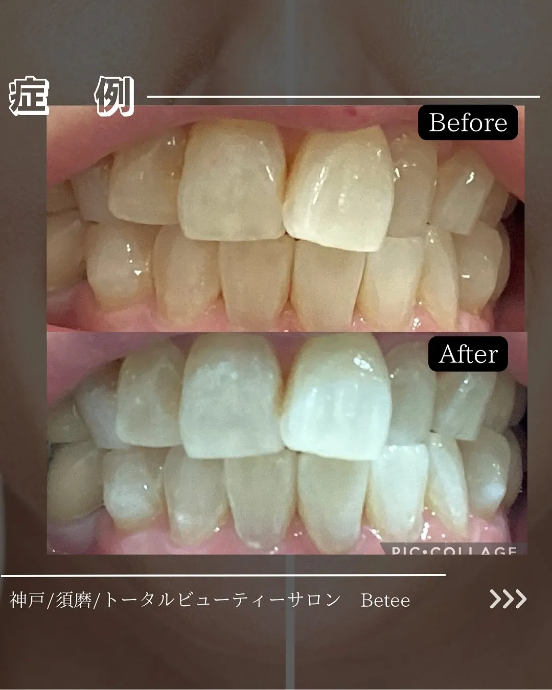 @whitening_betee ホワイトニング