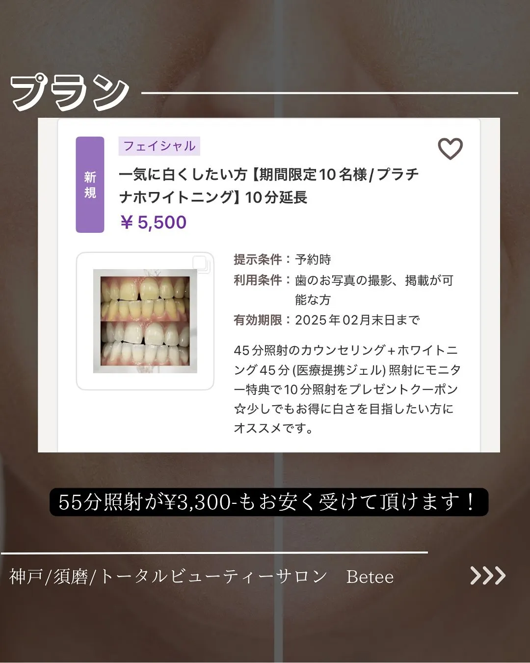 @whitening_betee ホワイトニング