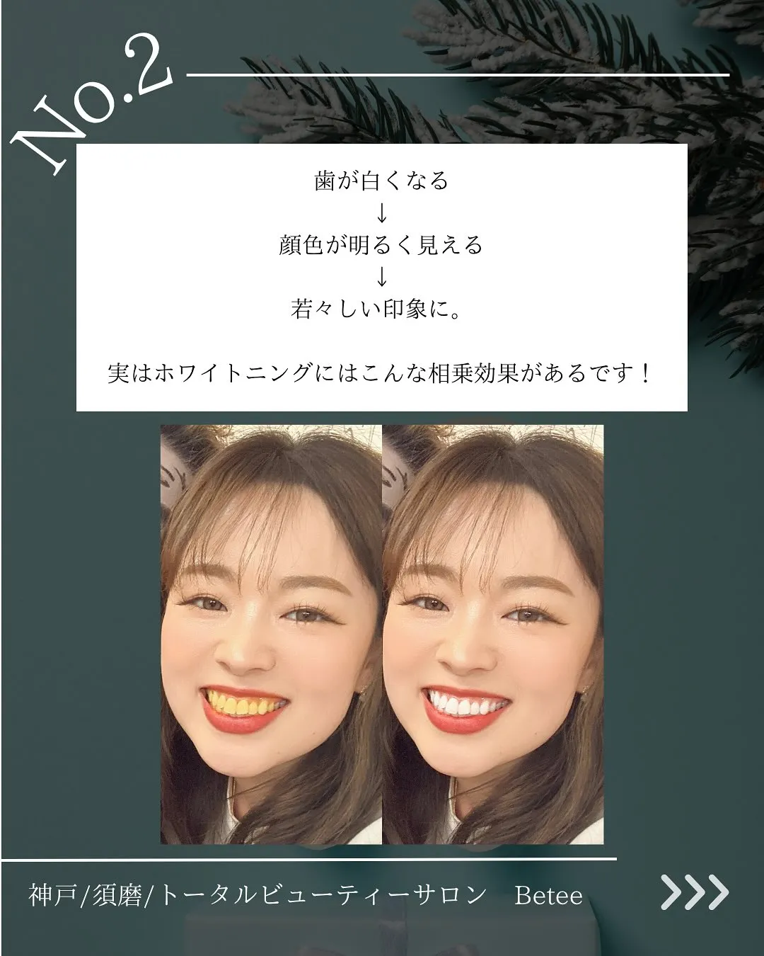 @whitening_betee ホワイトニング
