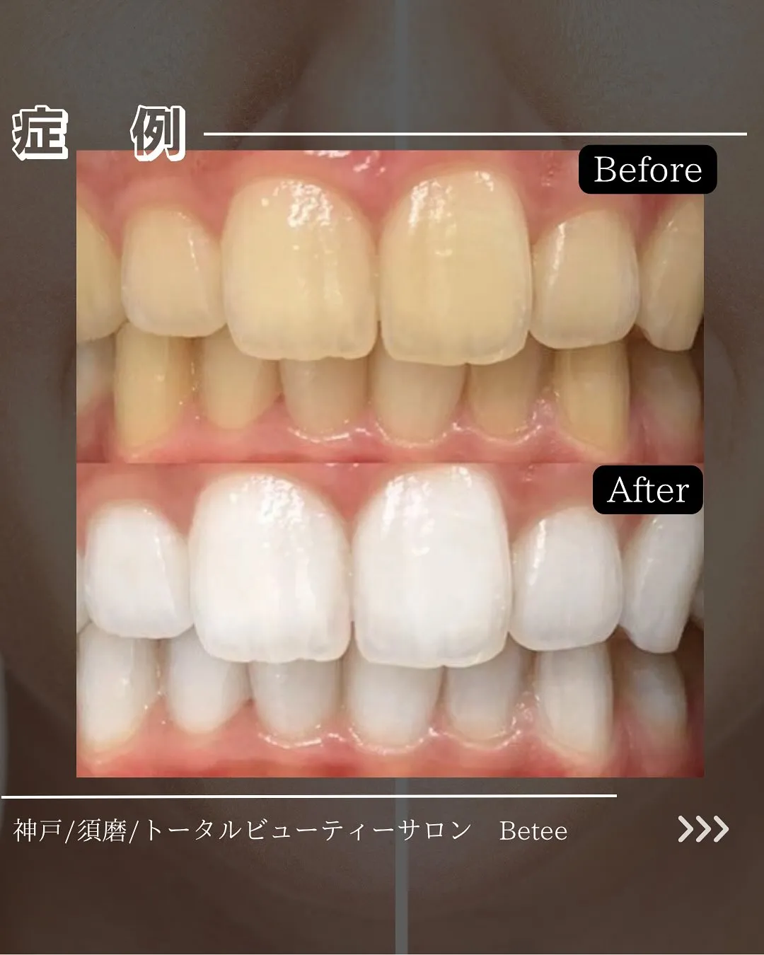 @whitening_betee ホワイトニング
