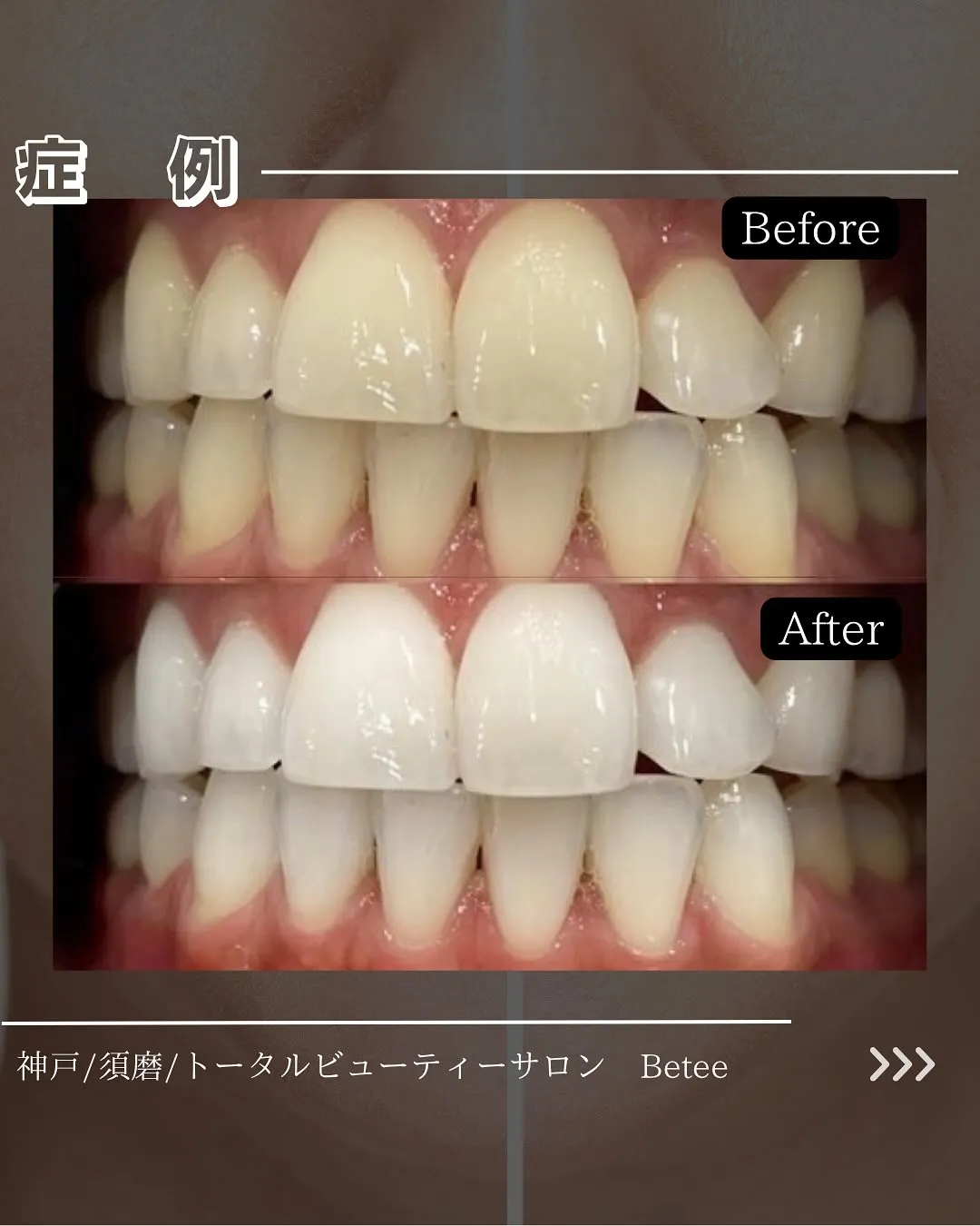 @whitening_betee ホワイトニング