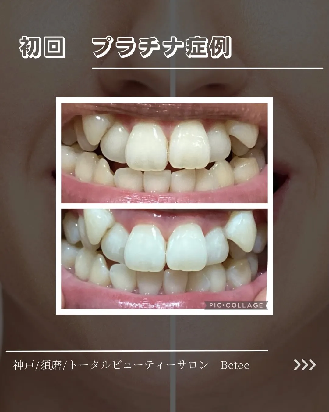 【1回ホワイトニング症例🦷】