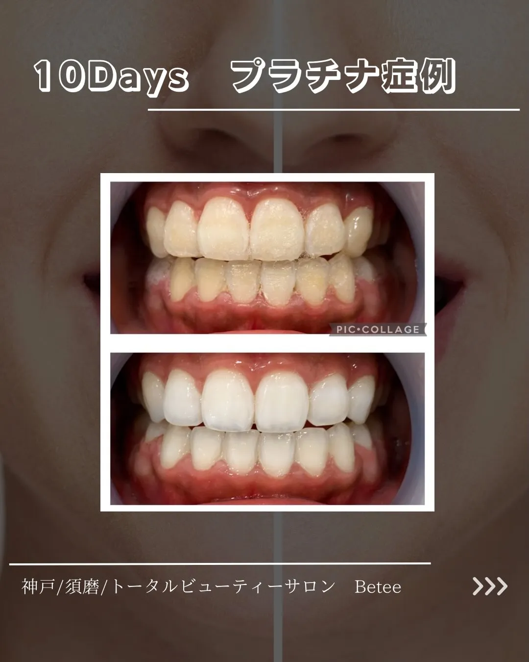 【10回ホワイトニング症例🦷】