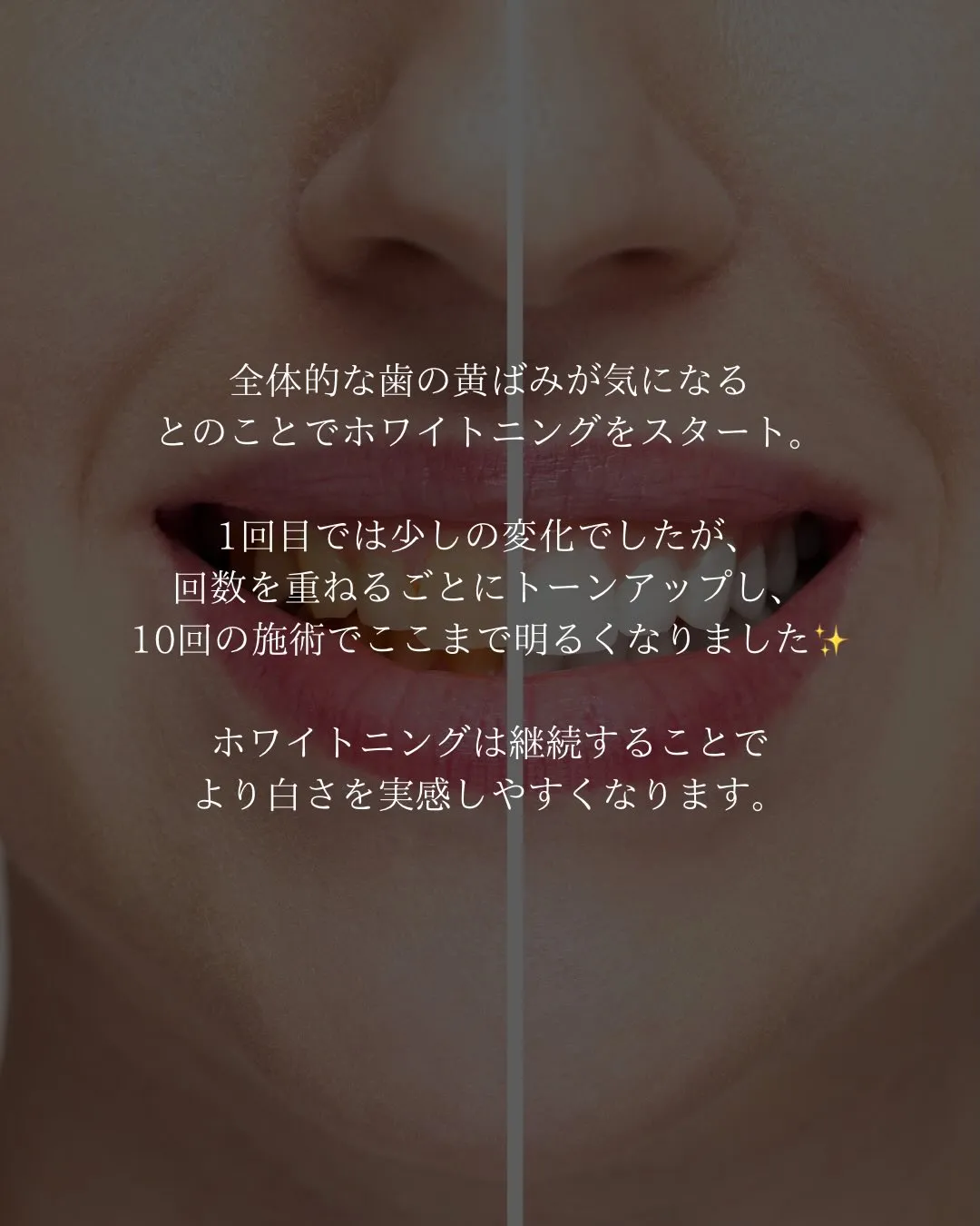 【10回ホワイトニング症例🦷】