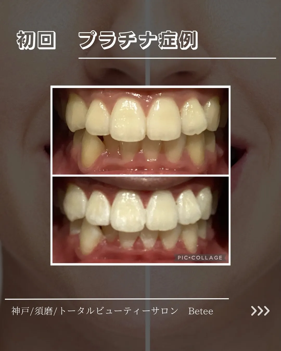 【1回ホワイトニング症例🦷】