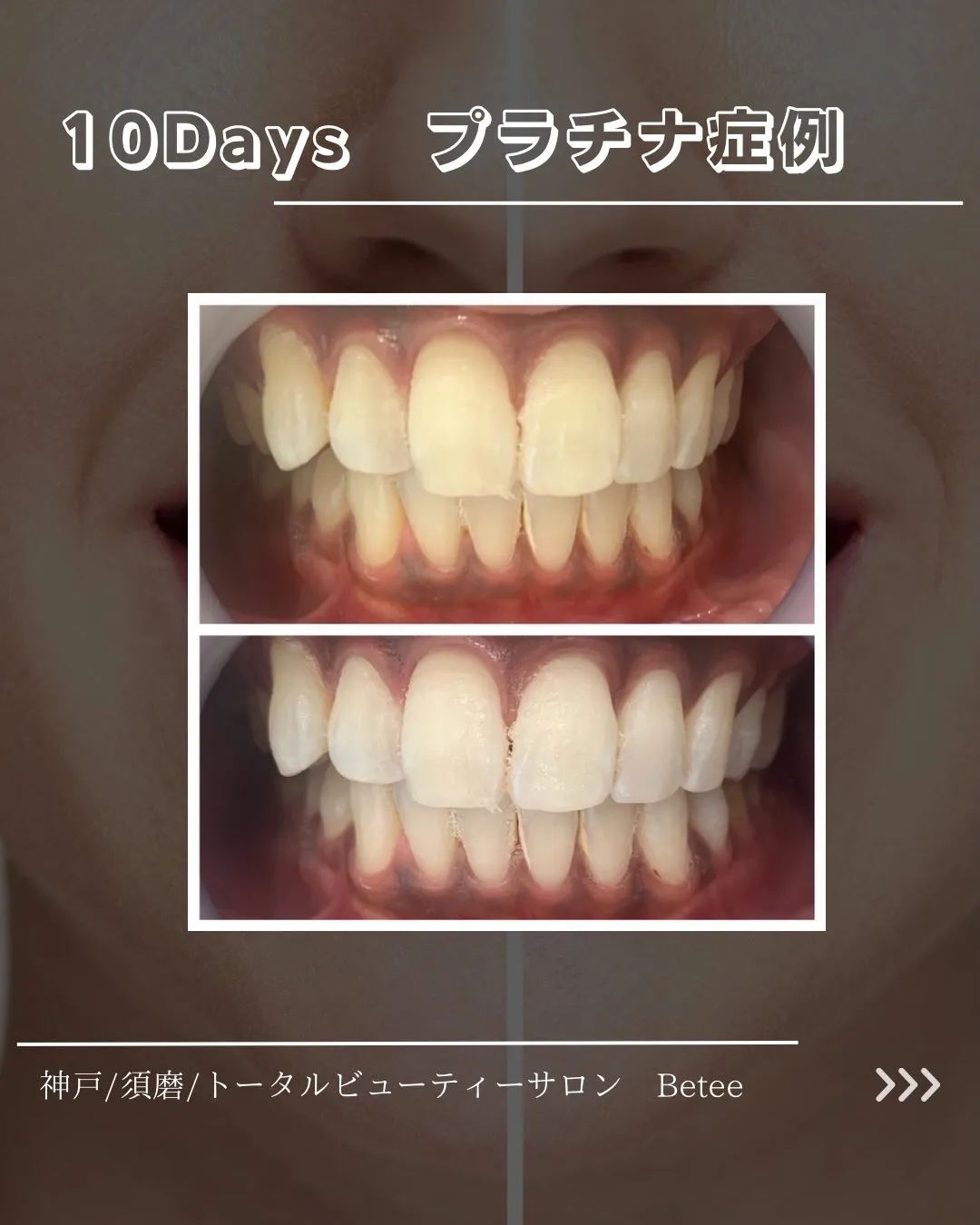 【10回ホワイトニング症例🦷】