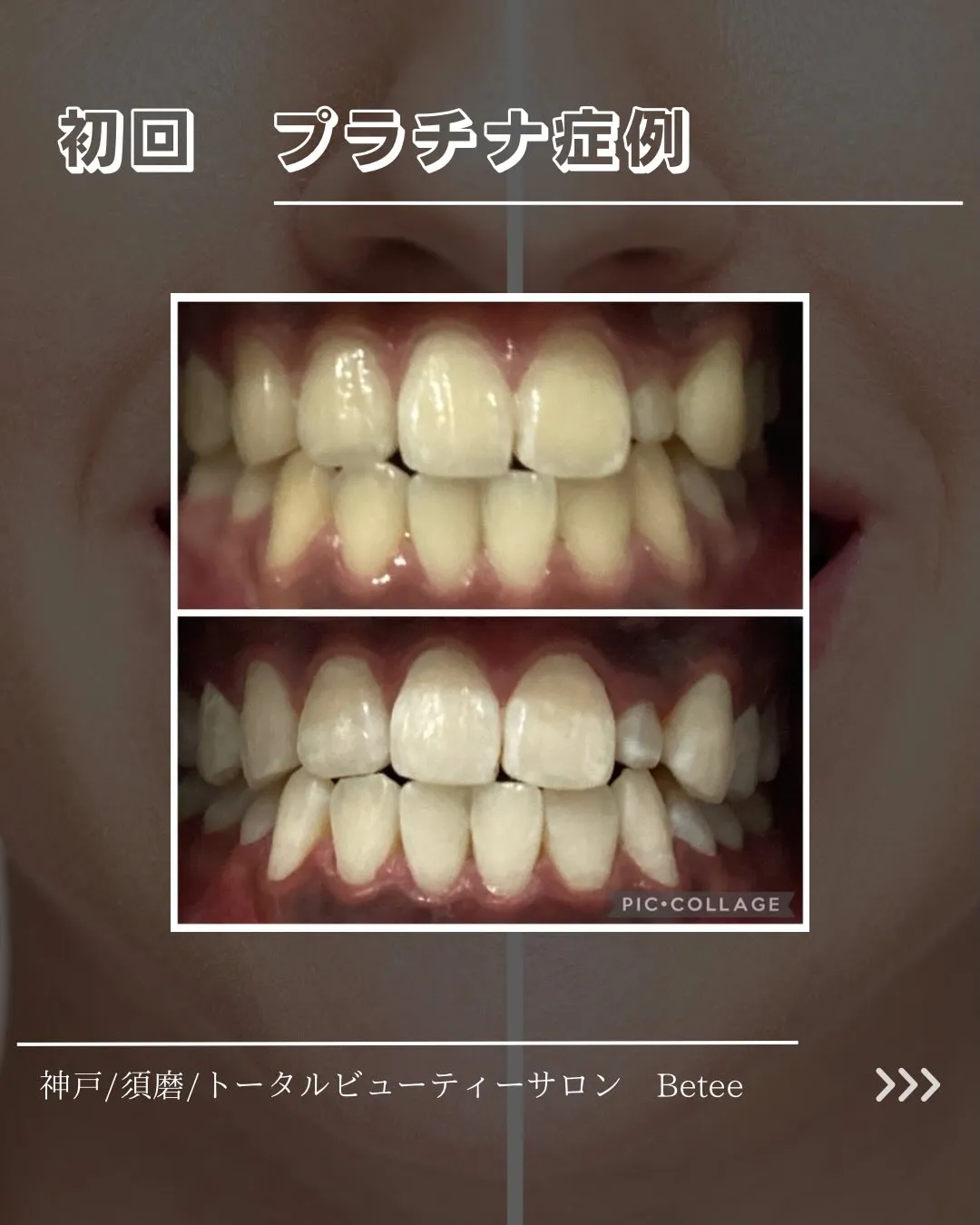 【1回ホワイトニング症例🦷】