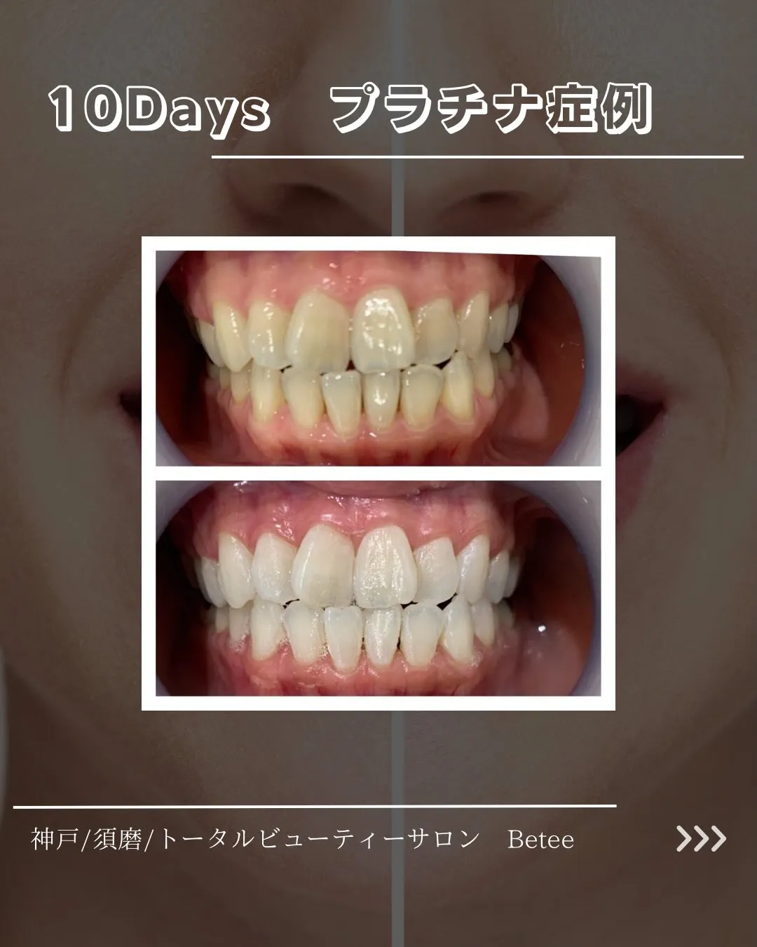 【10回ホワイトニング症例🦷】