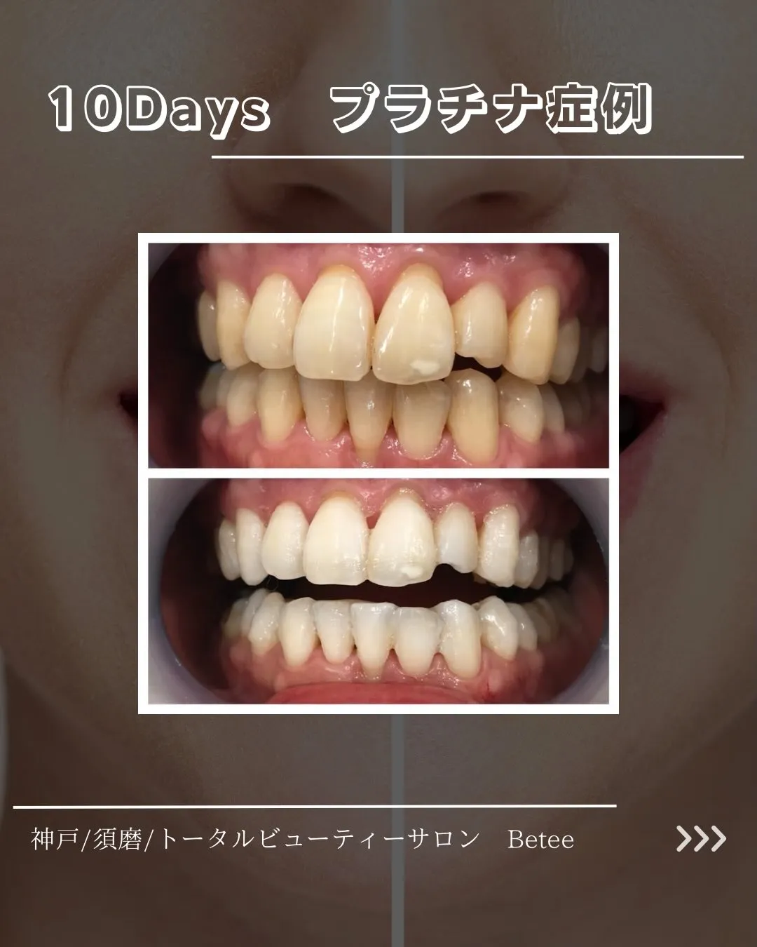 【10回ホワイトニング症例🦷】