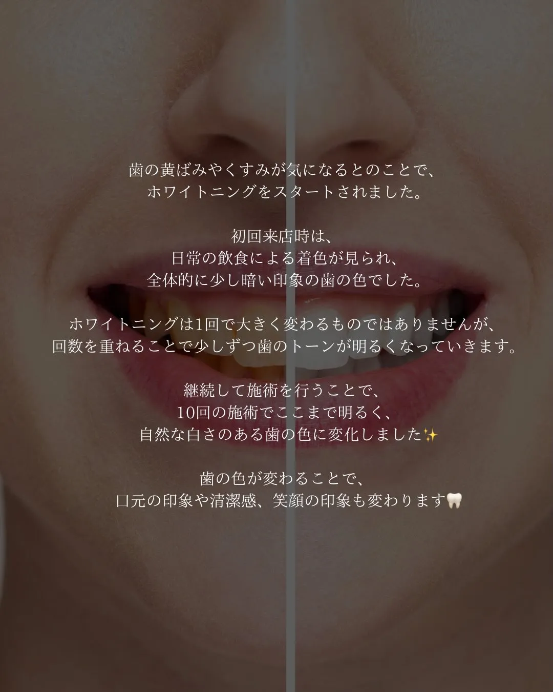 【10回ホワイトニング症例🦷】