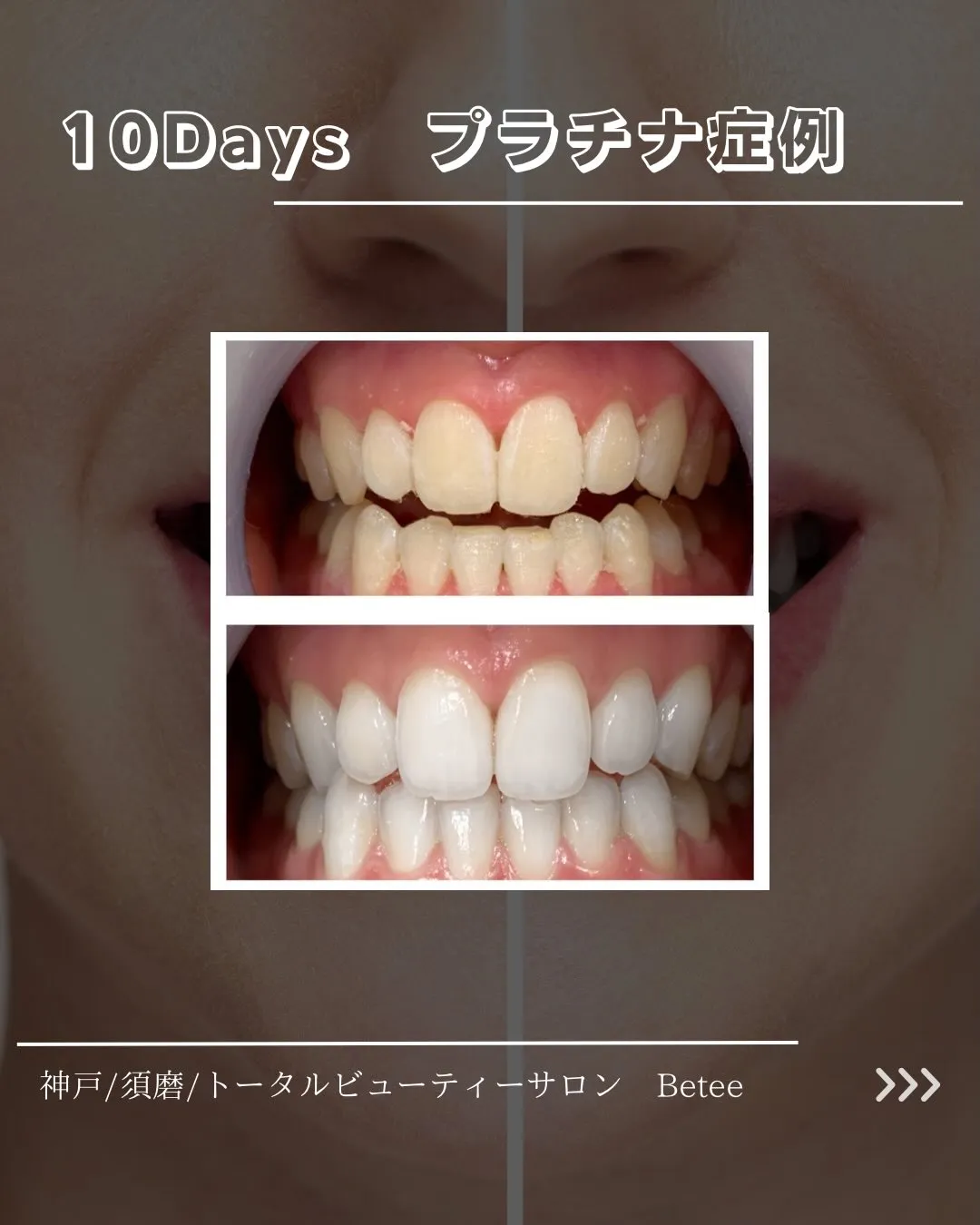【10回ホワイトニング症例🦷】