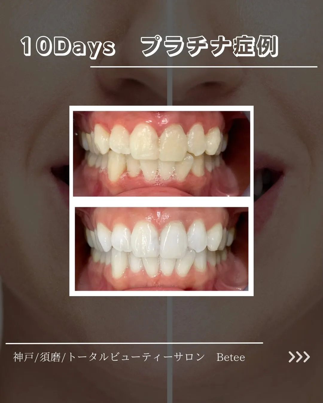 【10回ホワイトニング症例🦷】
