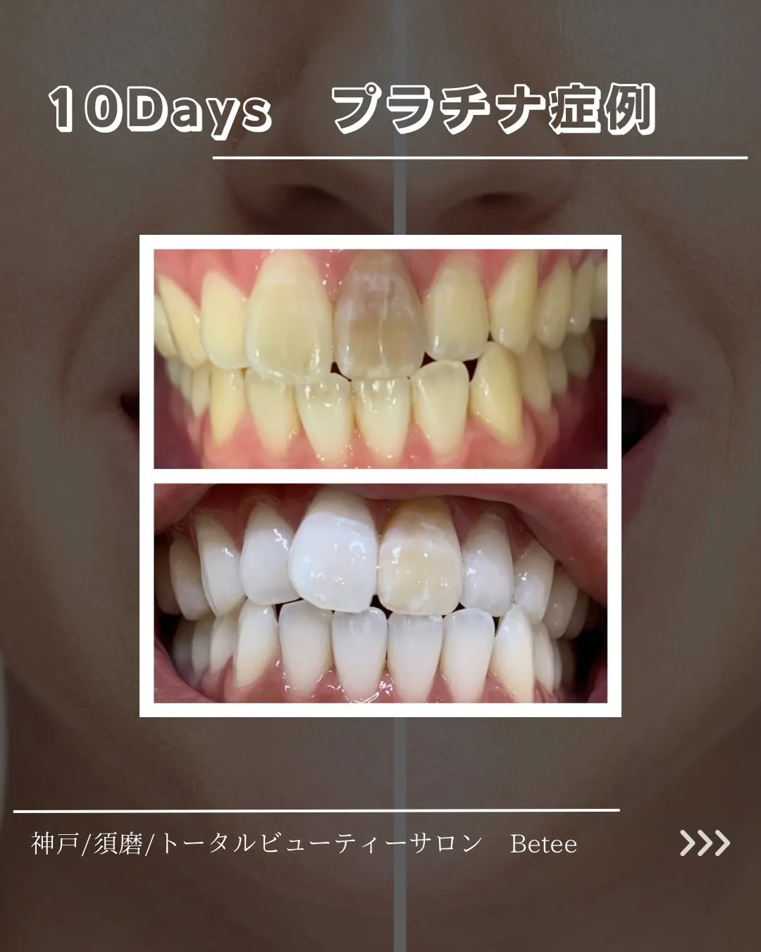【10回ホワイトニング症例🦷】