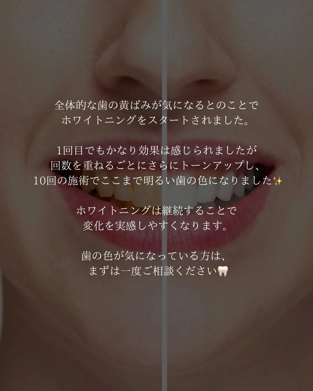 【10回ホワイトニング症例🦷】