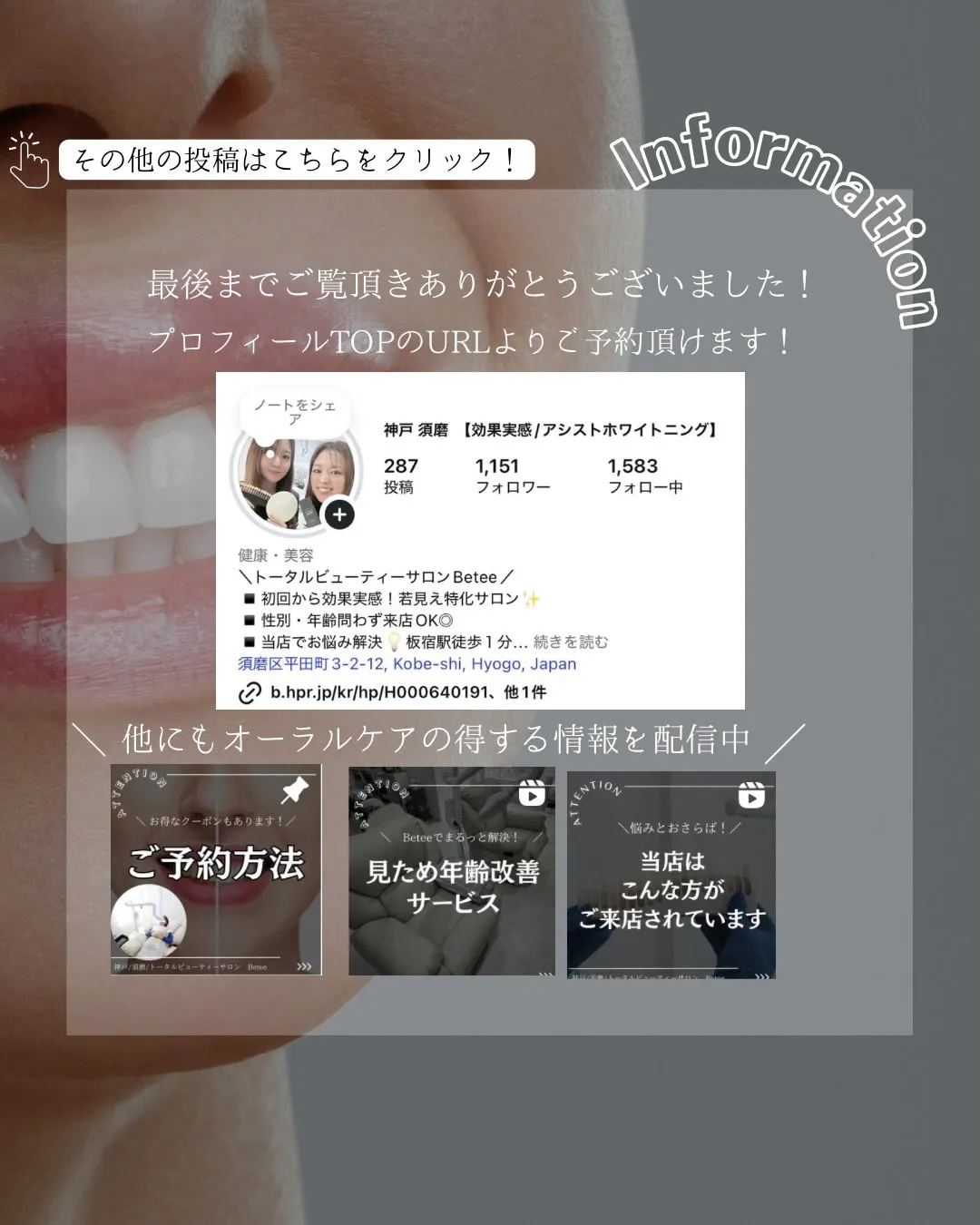 【10回ホワイトニング症例🦷】
