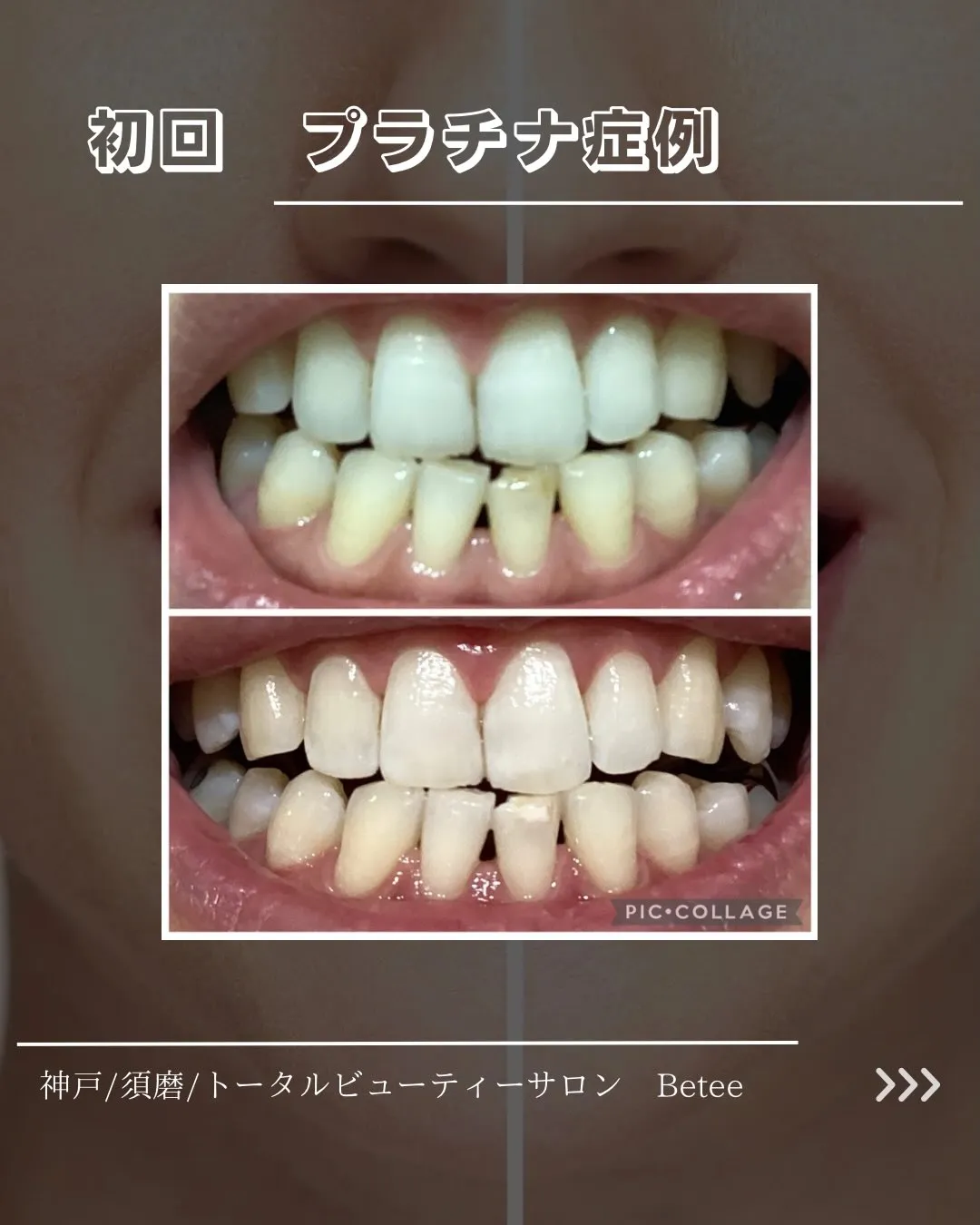 【初回ホワイトニング症例🦷】