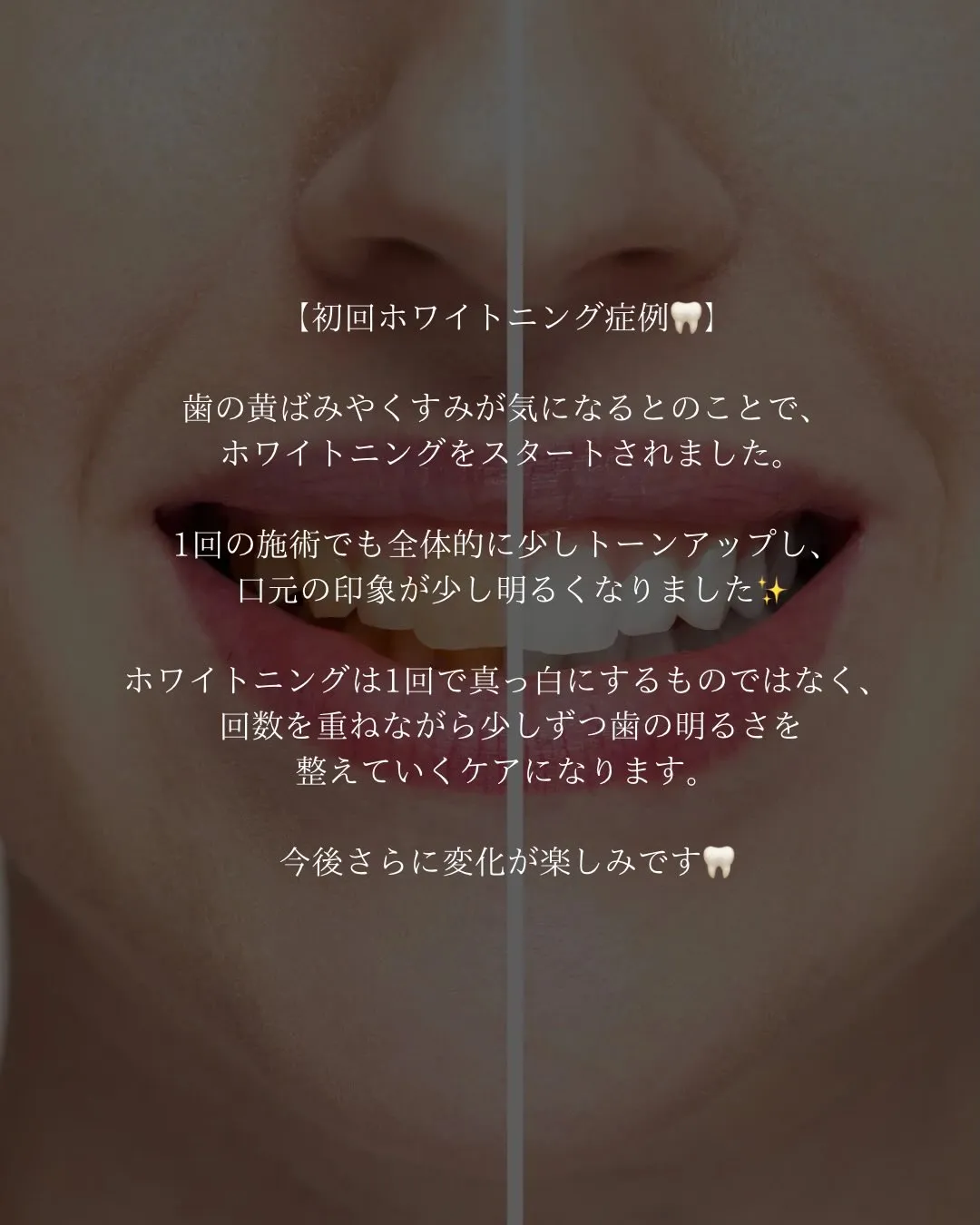 【初回ホワイトニング症例🦷】