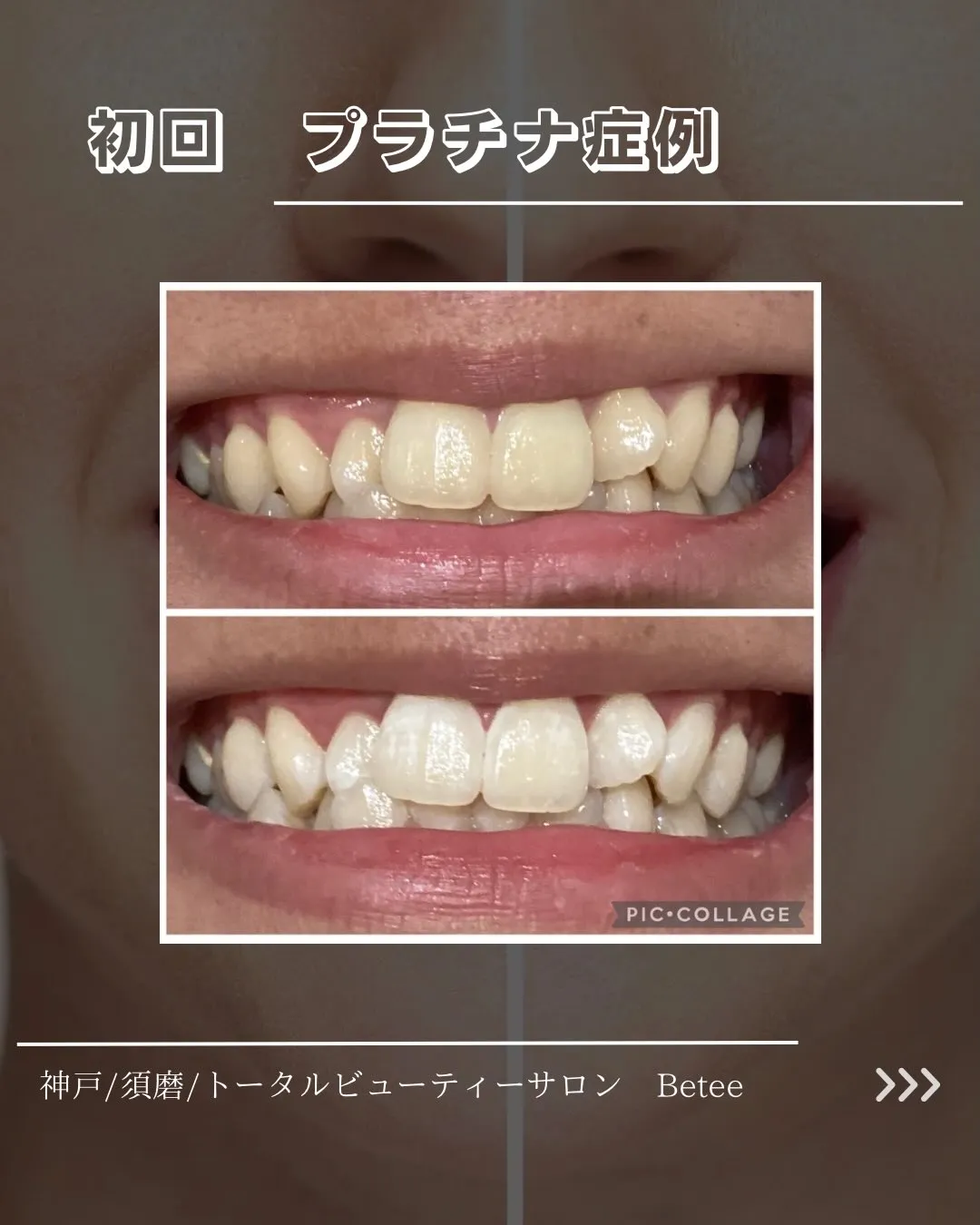 @whitening_betee 