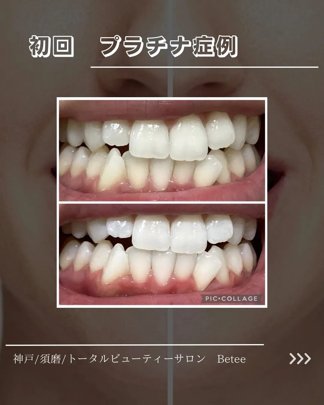 @whitening_betee 