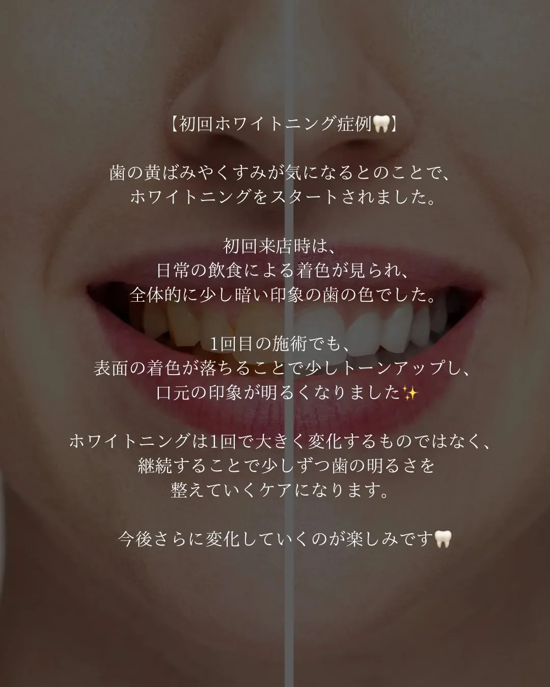 @whitening_betee 