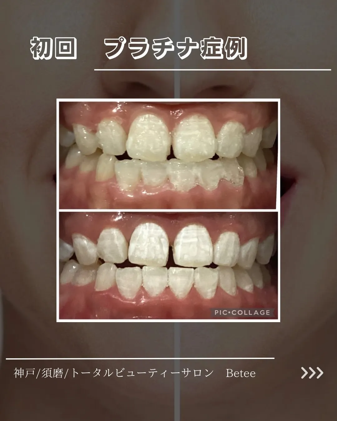 @whitening_betee 