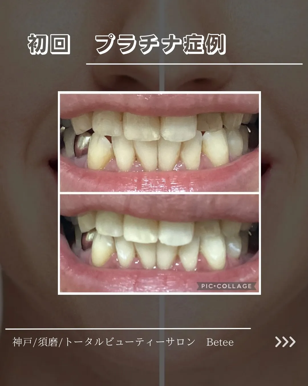 @whitening_betee