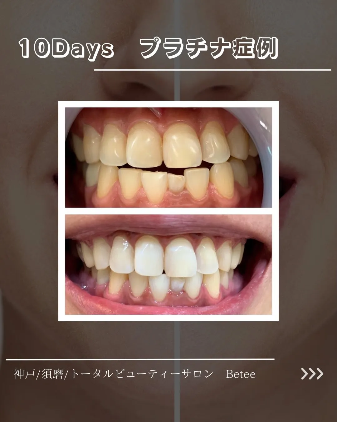 @whitening_betee 