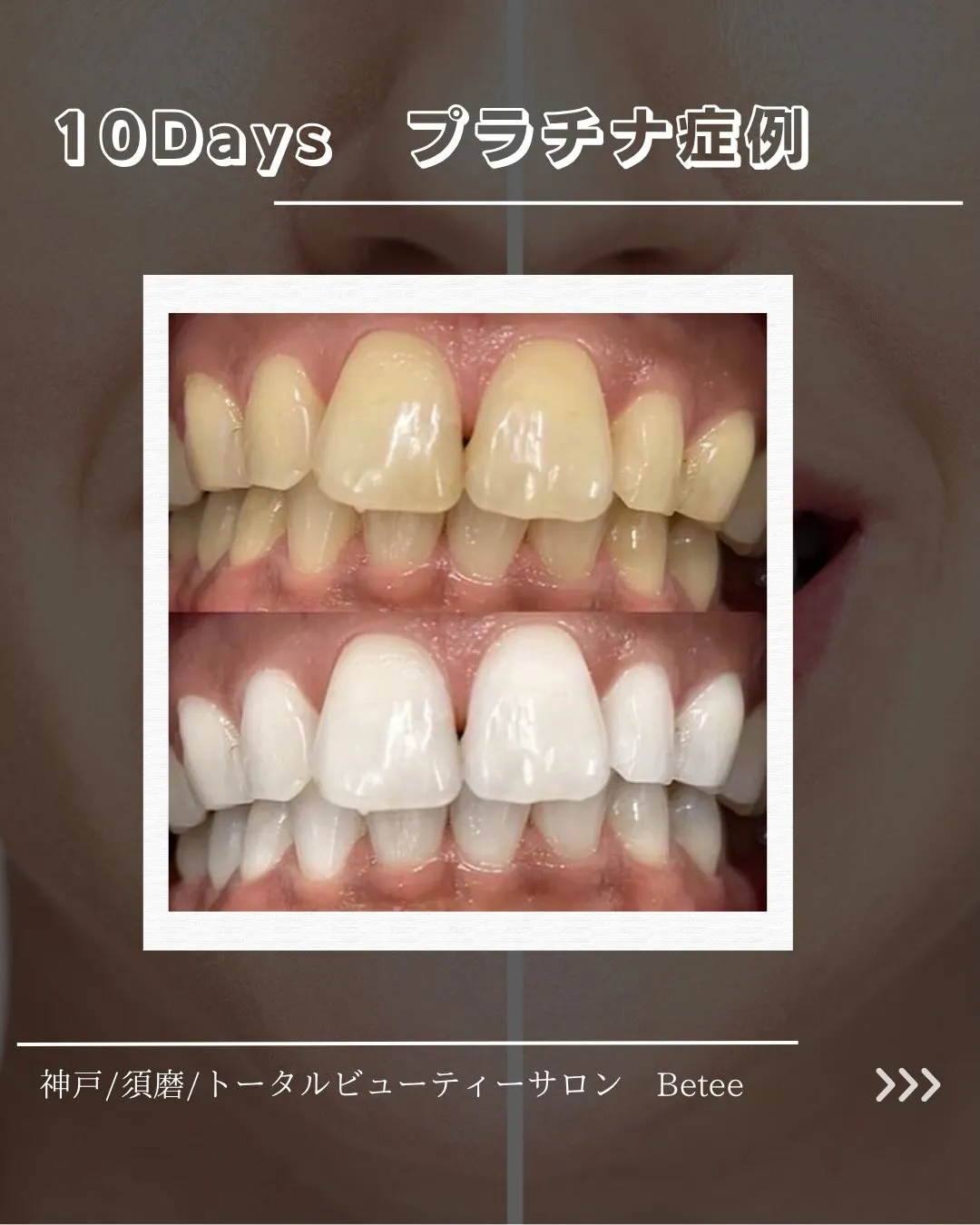@whitening_betee 